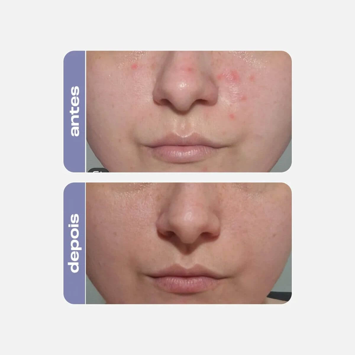 SÉRUM FACIAL CREAMY PRO-ADAPALENO 30G — imagem 3 | Farmácia Resyla