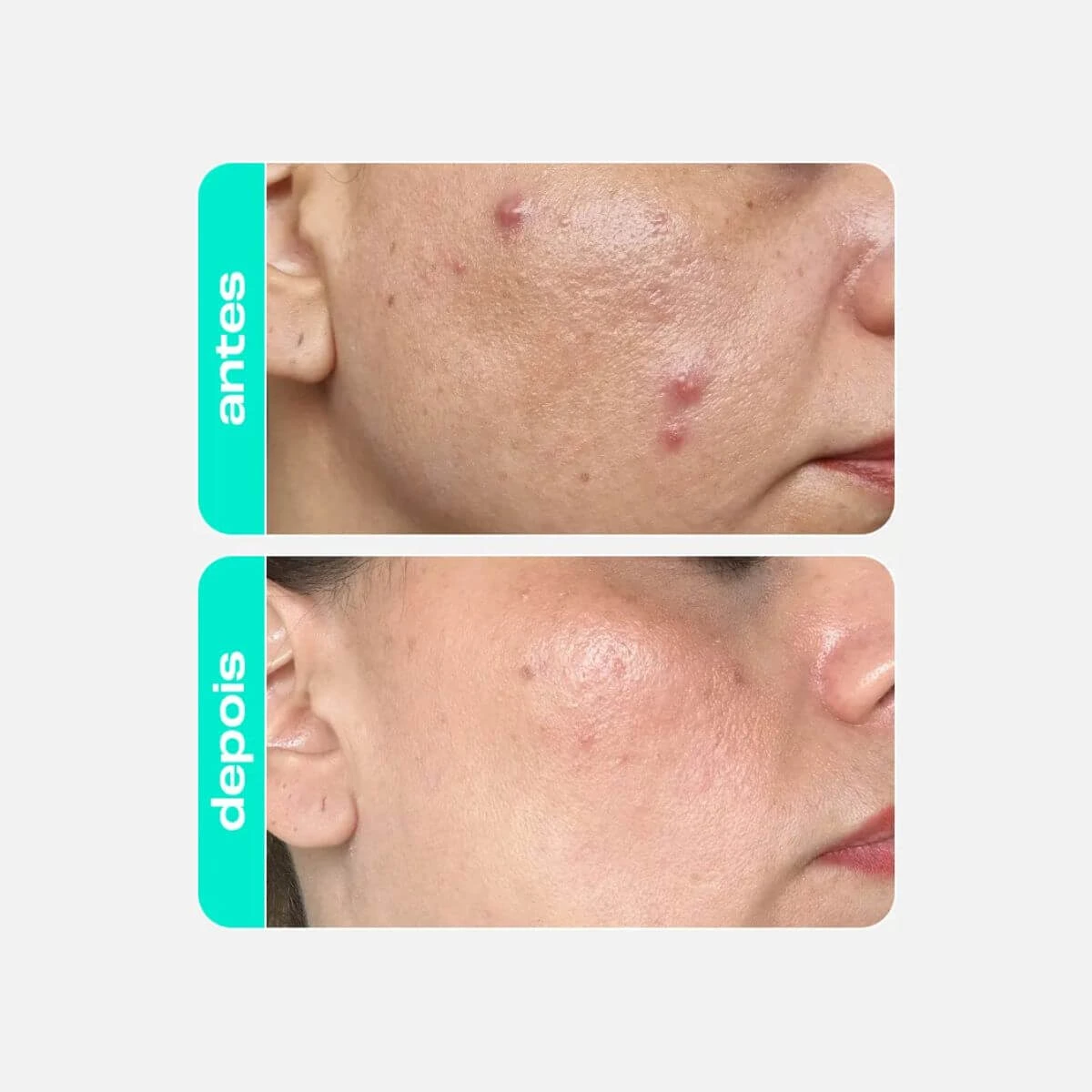 TÔNICO ANTIOLEOSIDADE ÁCIDO SALICÍLICO CREAMY 90ML — imagem 4 | Farmácia Resyla