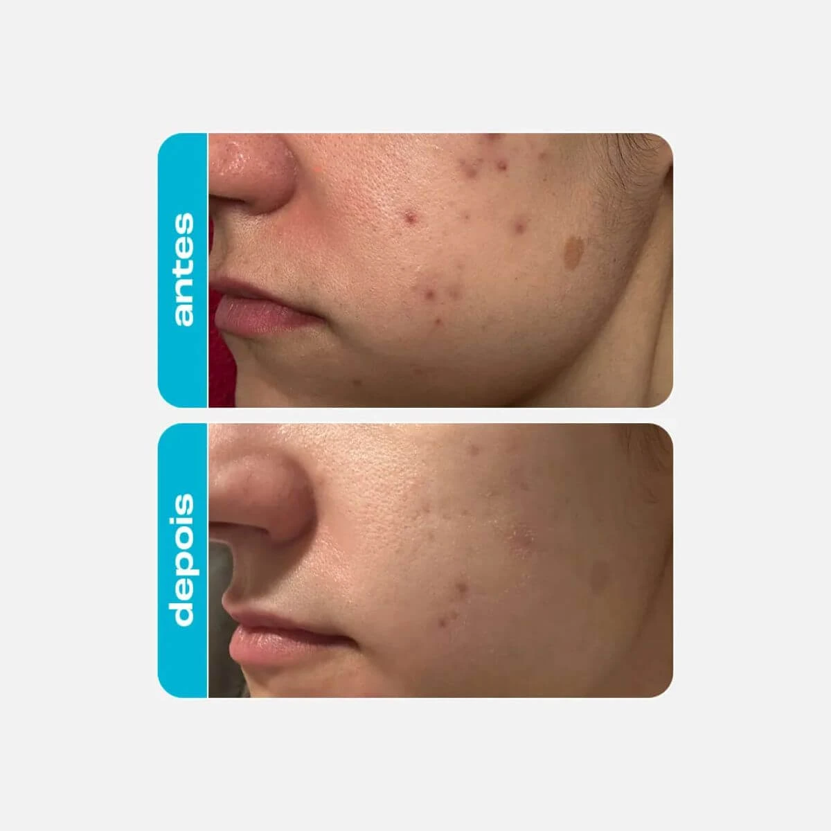 ESFOLIANTE QUÍMICO ÁCIDO GLICÓLICO CREAMY 30G — imagem 2 | Farmácia Resyla
